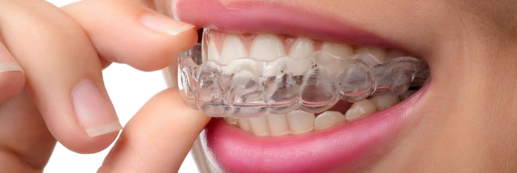 Clear Aligners in the mouth