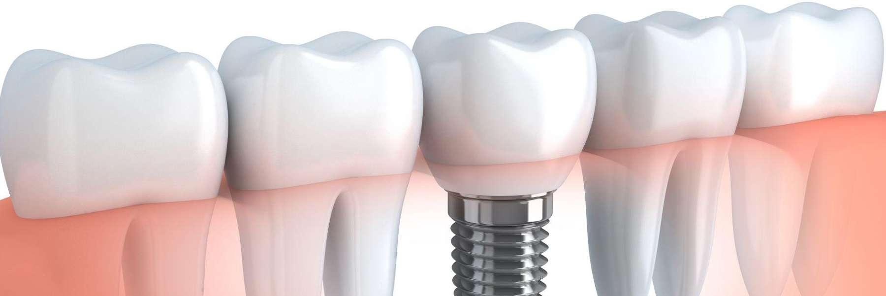 Dental Implant image with screw