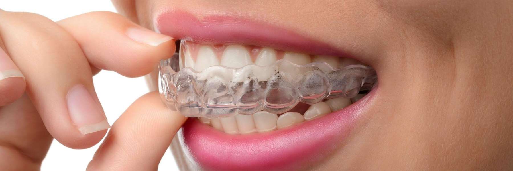 Invisalign in the mouth
