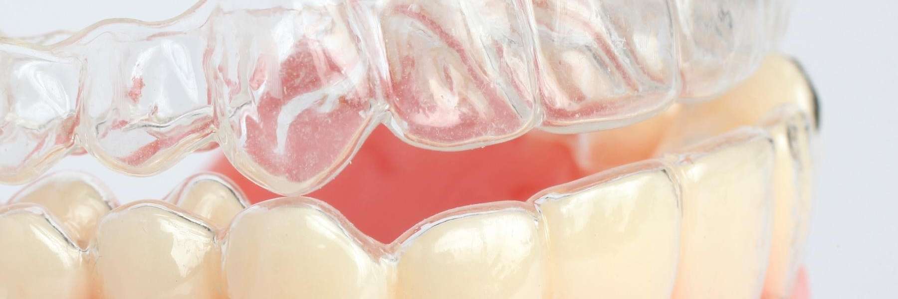 clear aligners out of tray