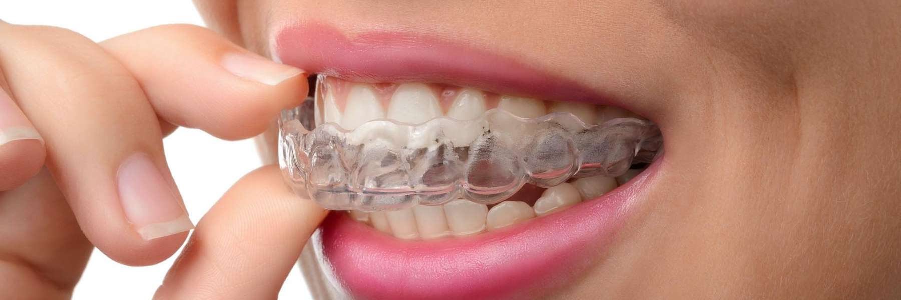 holding Clear Aligners in the mouth