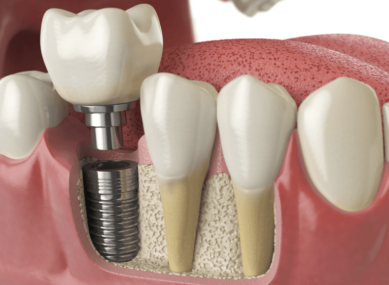 dental implant illustration