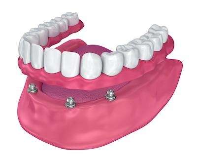 full smile restoration in evansville in