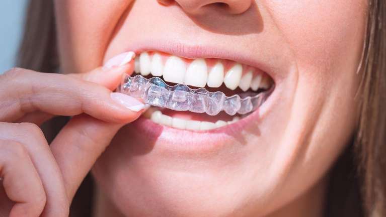 clear aligner placing in the mouth