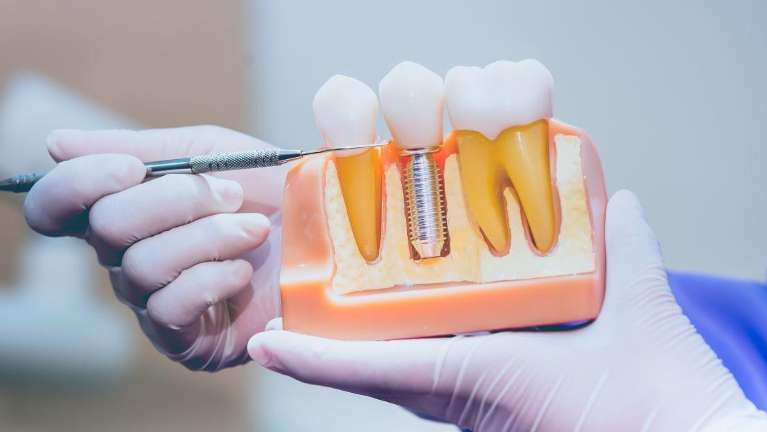 dental implant illustration