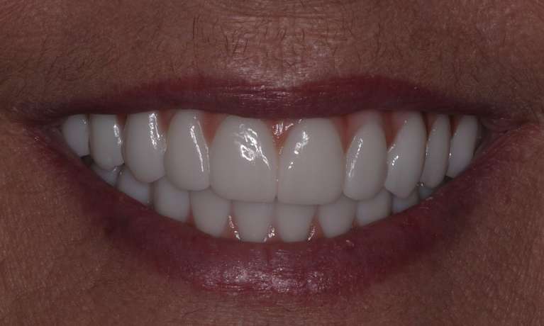 After All-on-X Implant-Supported Dentures in Evansville
