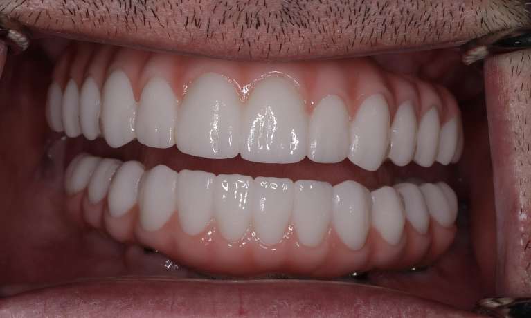 After All-on-X Implant-Supported Dentures in Evansville, IN