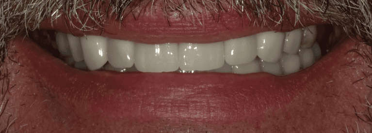 new bright smile after smile makeover