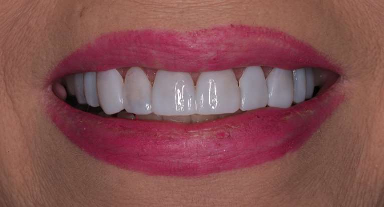 Free-Trial-Smile-After-Image