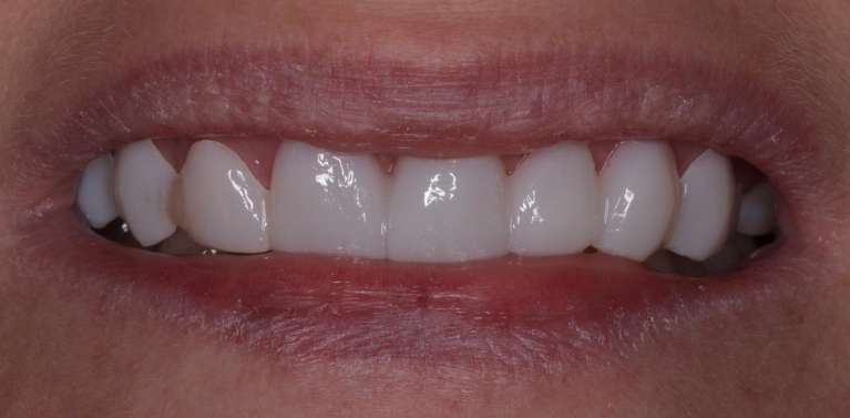 Free-Trial-Smile-After-Image