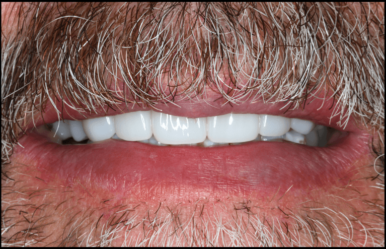 Full-Mouth-Rehab-After-Image