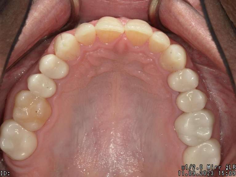 new, tooth-colored fillings