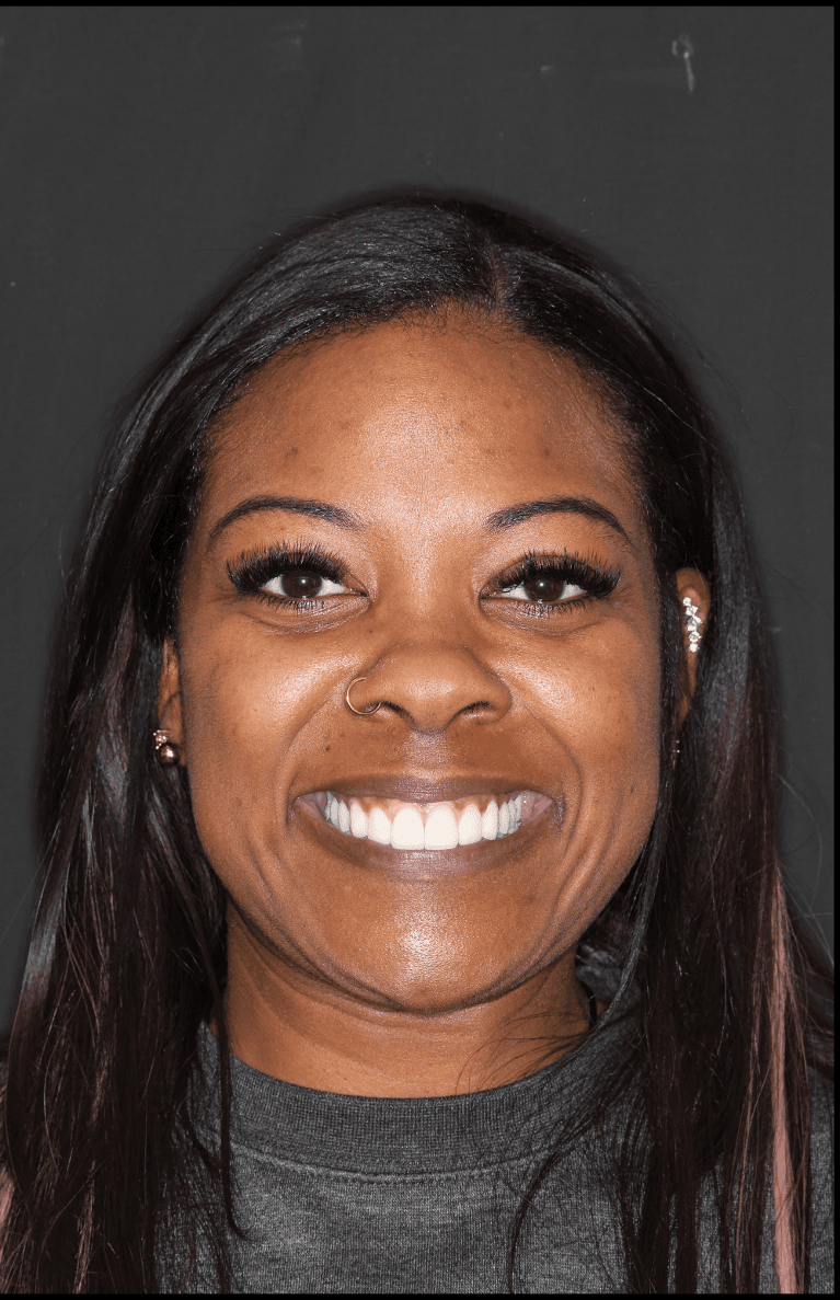 Gum-Lift-and-Cosmetic-Crowns-After-Image
