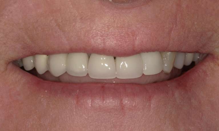 Tooth-Replacement-with-Dental-Implants-After-Image