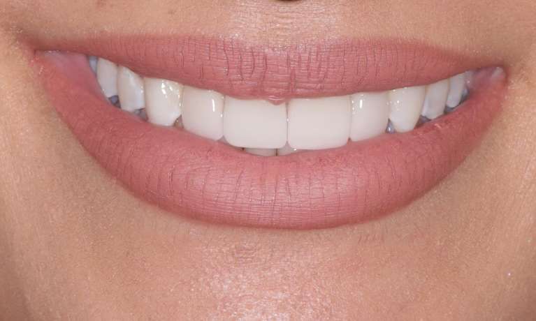 After Invisalign and Cosmetic Crowns