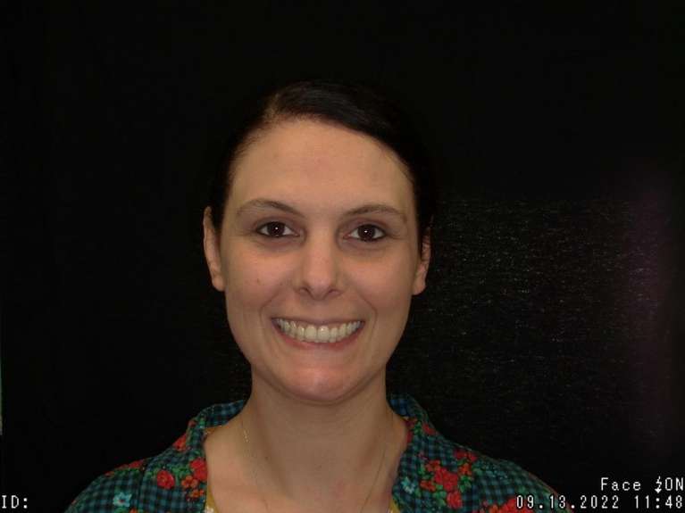 patient with straighter smile after invisalign