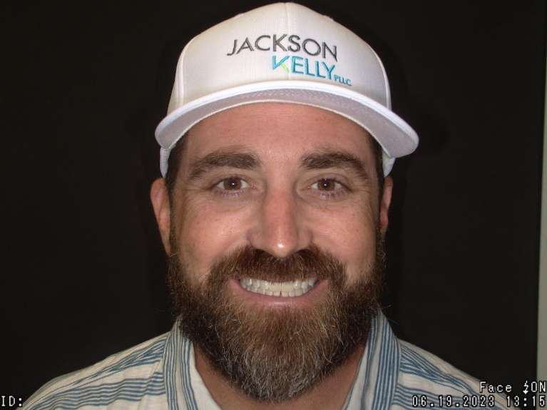 patient after invisalign