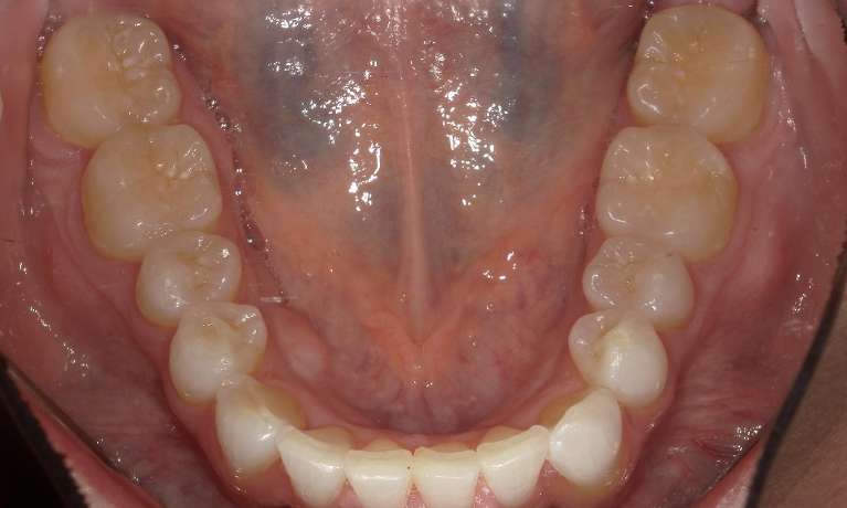 straight bottom teeth after invisalign