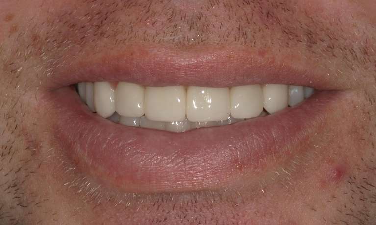 patient smiling after smile makeover