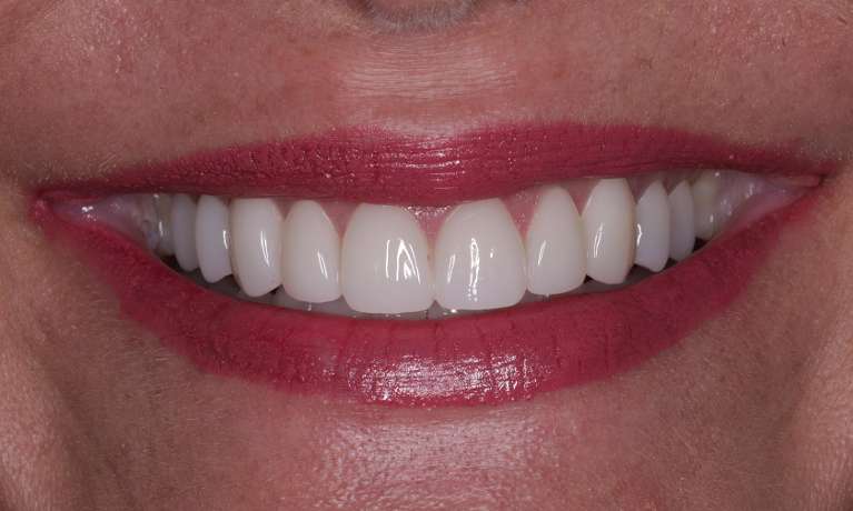 new front teeth after smile makeover