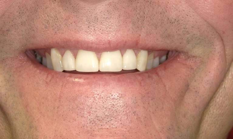 new teeth after smile makeover