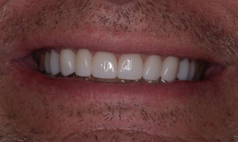 straight teeth after smile makeover