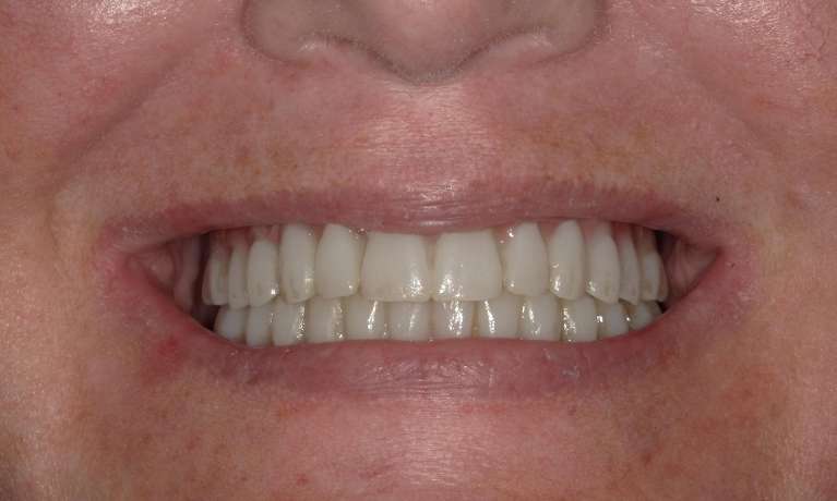 smile transformation after teeth in a day