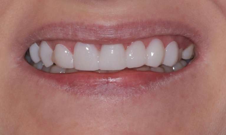 gap between front teeth closed after smile makeover