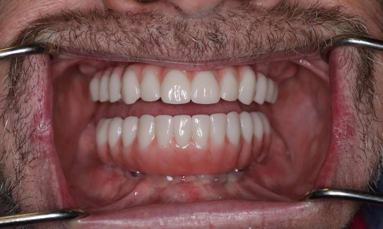 new smile after Upper and Lower All On X