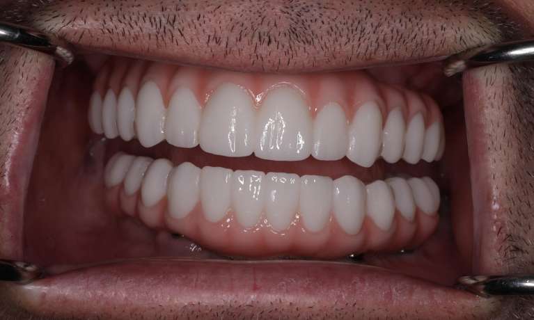 new smile after Upper and Lower All On X dentures