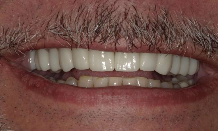 smile after crowns and whitening