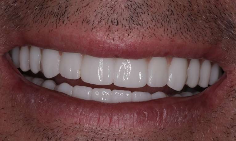 After All-on-X Implant-Supported Dentures