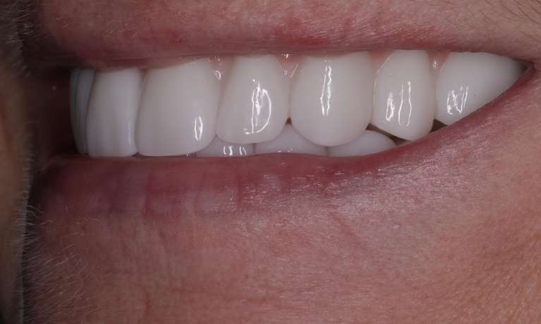 bright white smile after all on x dentures