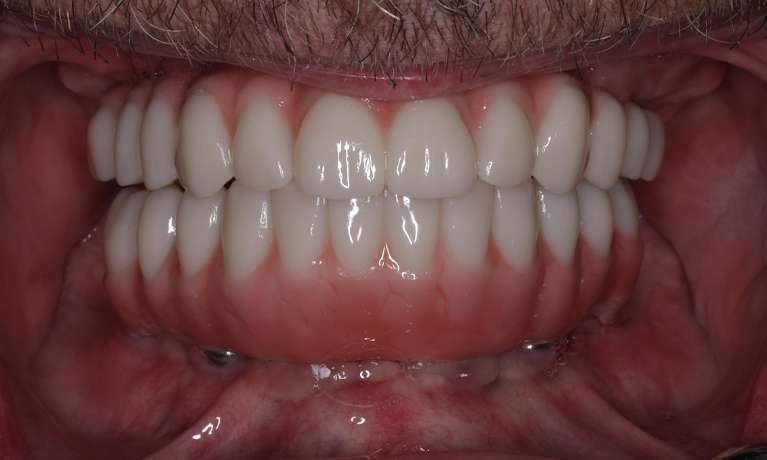 new bright smile after all on x dentures