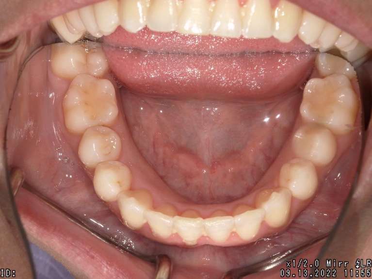 straight bottom teeth after invisalign