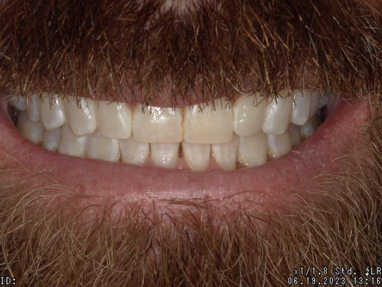 patient's after invisalign