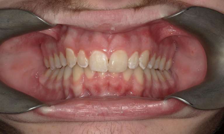 straight front teeth after invisalign