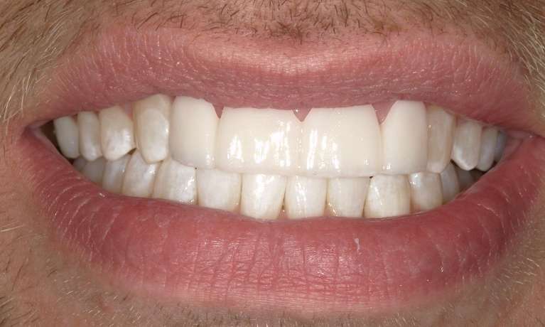 white teeth after smile makeover