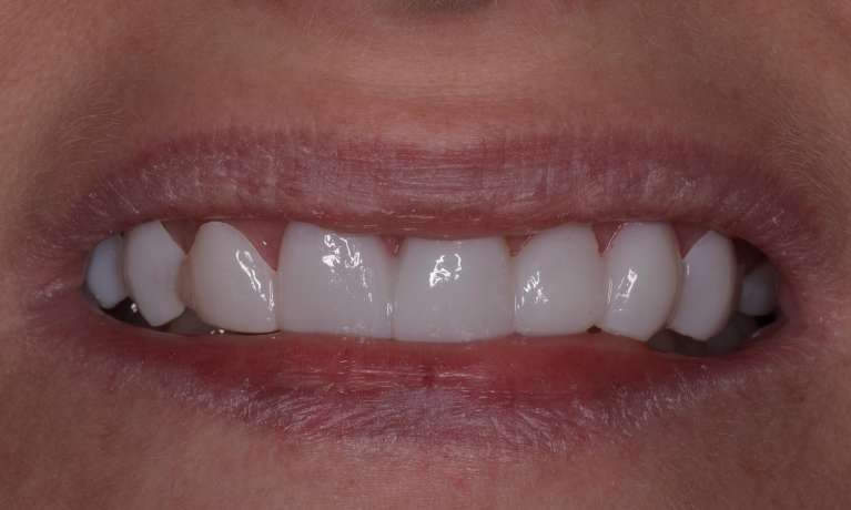 gap between front teeth closed after smile makeover