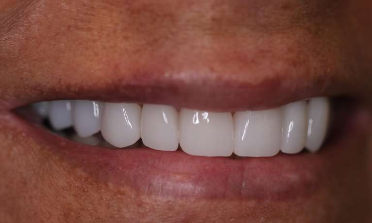 After Cosmetic Crowns Evansville IN