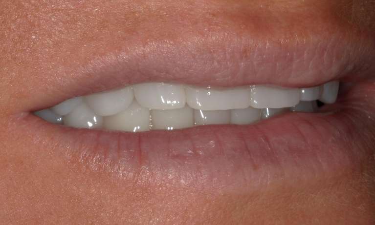 After Cosmetic Crowns in Evansville, IN
