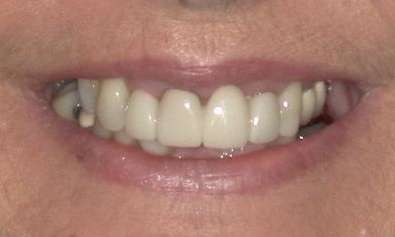 Before All-on-X Implant-Supported Dentures in Evansville