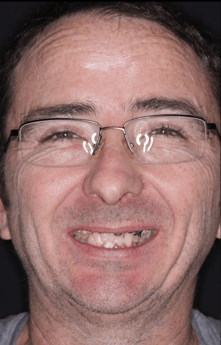 All-on-X-Before-Image