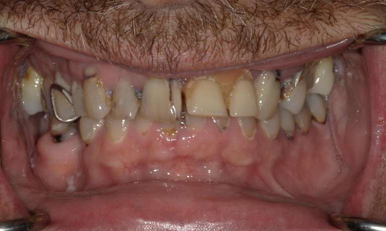 old and worn teeth