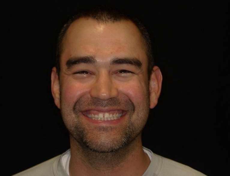 patient smiling before smile makeover