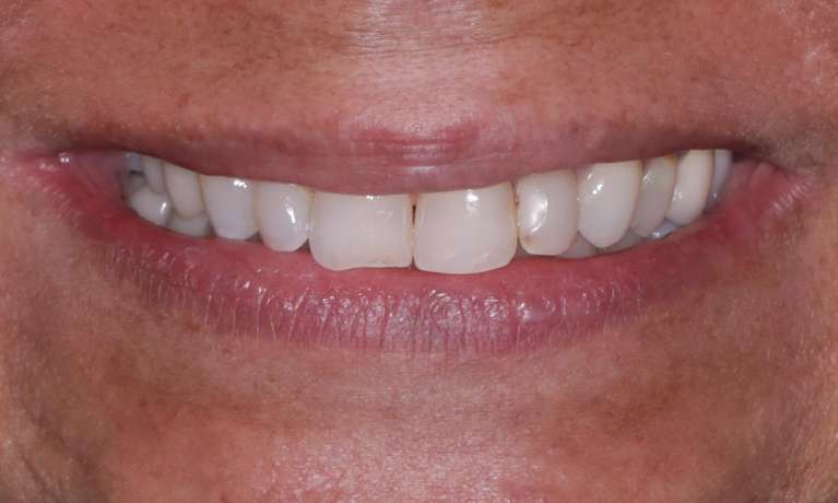 Before Cosmetic Crowns