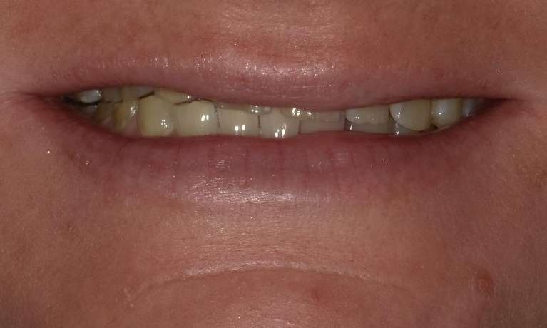 Before Cosmetic Crowns