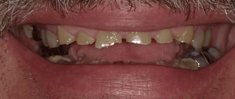 worn old teeth