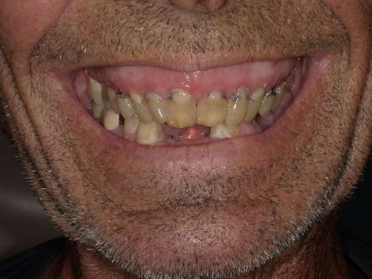 worn and missing teeth