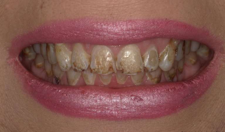 Free-Trial-Smile-Before-Image